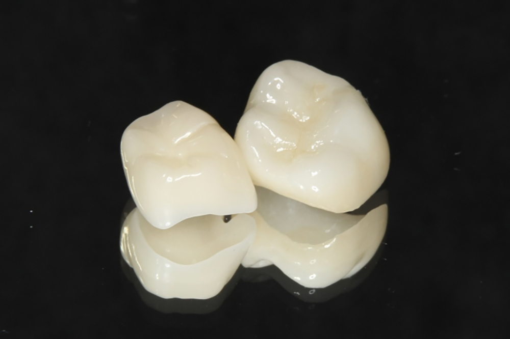 オールセラミック（インレー・クラウン）