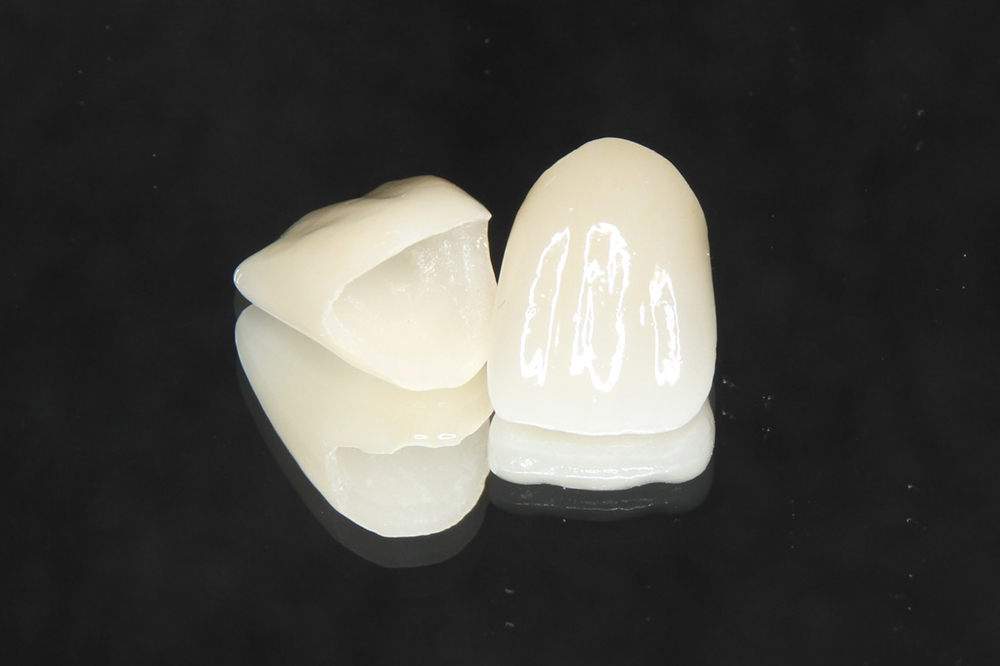 ジルコニア（インレー・クラウン）