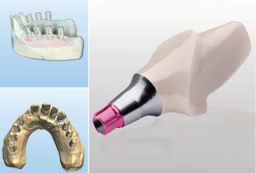 インプラント埋入手術
