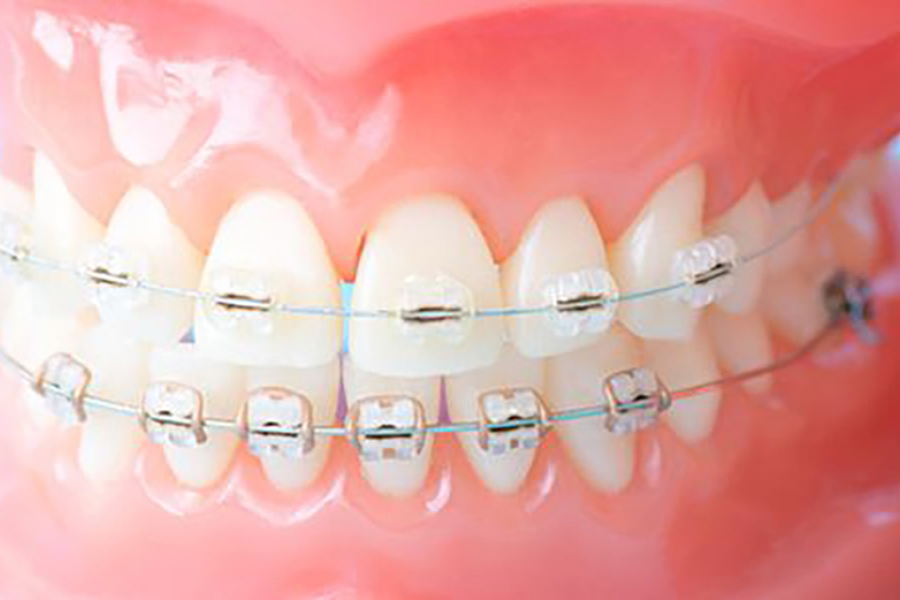 ブラケットとワイヤーの装着